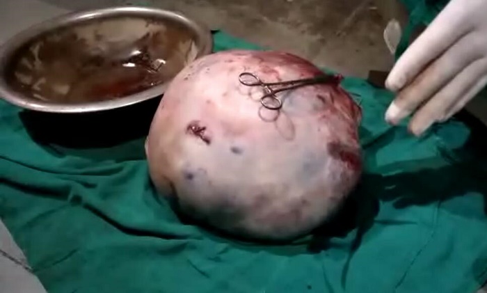Doctors remove 25 kg ovarian cyst from 72-yr-woman at Anantnag nursing home